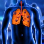 Бронхиальная пневмония - причины, симптомы и лечение