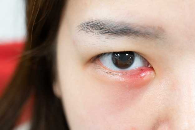Симптомы и лечение лопнувшего сосуда в глазу