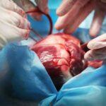Операция при перекруте яичка: причины, симптомы, подготовка - все, что нужно знать
