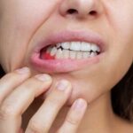 Раздражение и покраснение вокруг рта: причины и лечение
