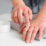 Сухость кожи рук и ног: причины и эффективные средства увлажнения