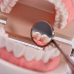Виды зубных протезов: классификация, описание, правила ухода